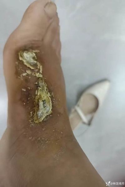 伤口深怎么处理_伤口深需要缝针吗