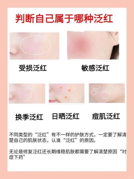脸通红是什么原因_脸通红怎么快速缓解