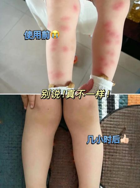 破皮用什么药好得快_破皮后怎么护理不留疤