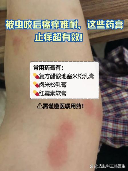 什么虫咬人又痒又痛_怎么快速止痒消肿