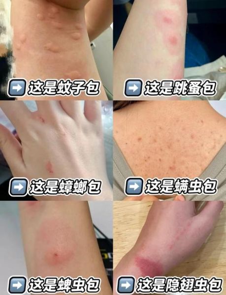 什么虫咬人又痒又痛_怎么快速止痒消肿