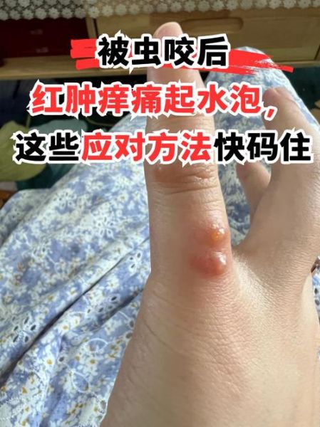 什么虫子咬了会起水泡_被虫子咬后水泡怎么处理