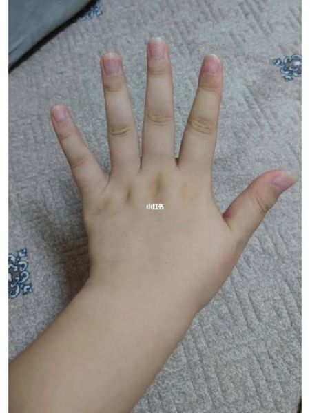 手胖怎么快速瘦下来_手胖的原因有哪些