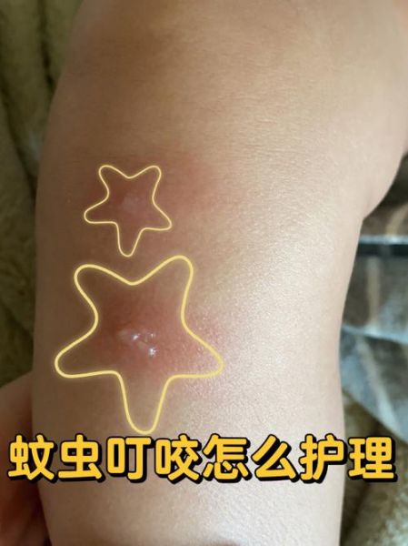 什么虫子咬了会起水泡_怎么快速止痒消肿