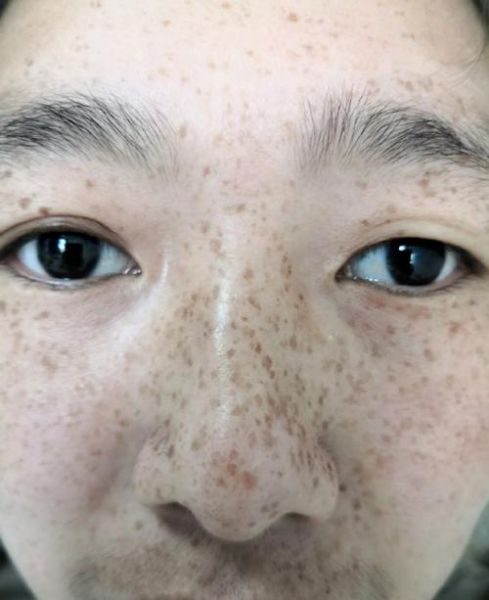 雀斑影响财运吗_雀斑面相财运解析