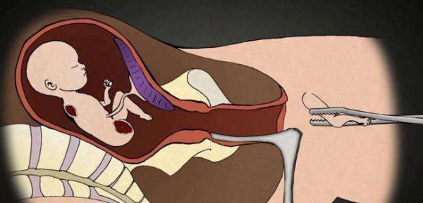 人流后会影响财运吗_人流后财运变差怎么办