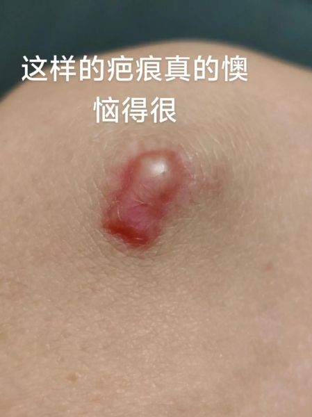 疤痕会影响运势吗_如何化解疤痕带来的厄运
