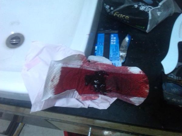 梦见自己排出大血块_是什么意思