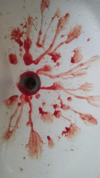 梦到被打出血_梦见被打出血预示什么