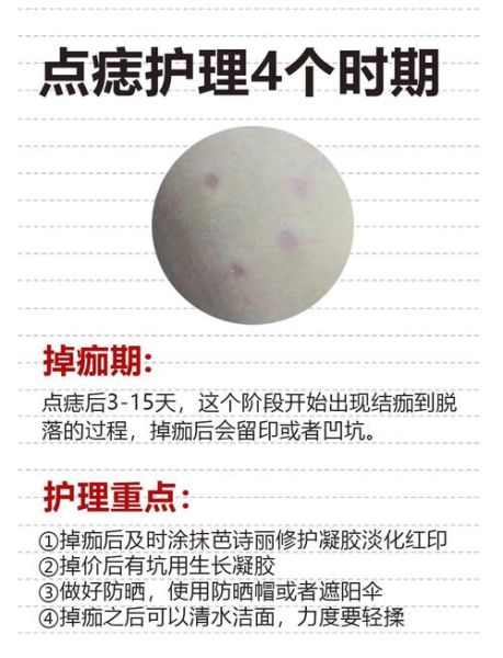 点痣会影响运势吗_去痣后运气真的会变吗