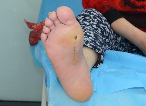 梦到截肢是什么意思_梦见自己截肢了怎么办