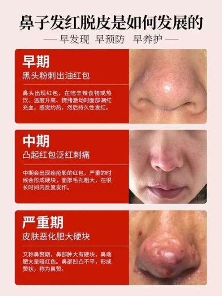 鼻子红是财运好吗_鼻子发红代表什么