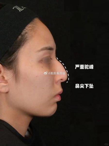 驼峰鼻财运女面相解析_驼峰鼻女人旺夫吗