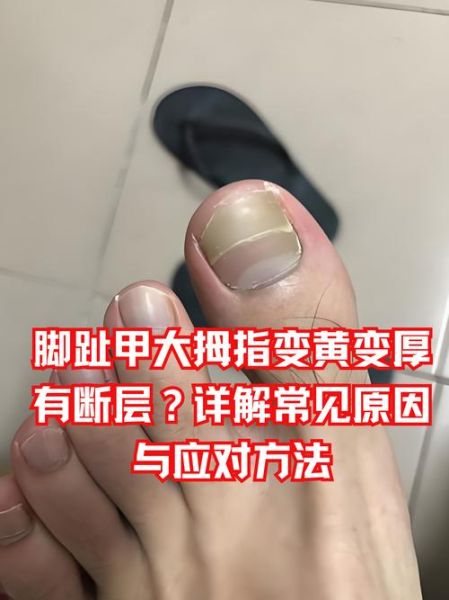 梦到脚趾断了_有什么预兆