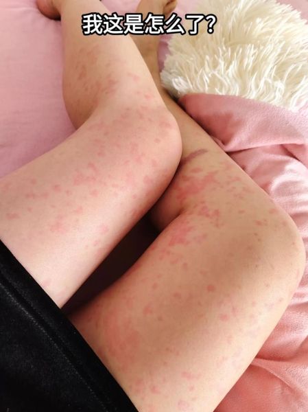 梦到起疹子是什么意思_梦见身上长红疹预示什么