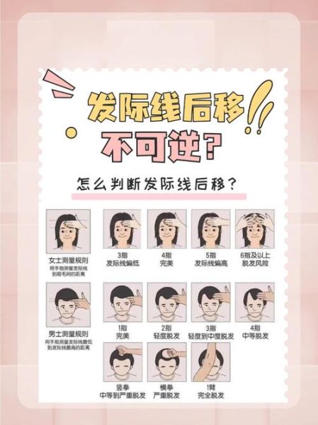 脱发际线会影响运势吗_发际线后移风水说法