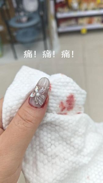 梦到指甲盖掉了_梦见指甲脱落是什么意思