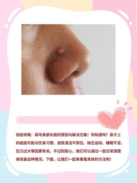鼻子长痘影响财运吗_如何破解鼻子长痘的财运危机