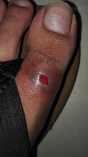 梦到流血脓是什么意思_梦到流血脓预示什么