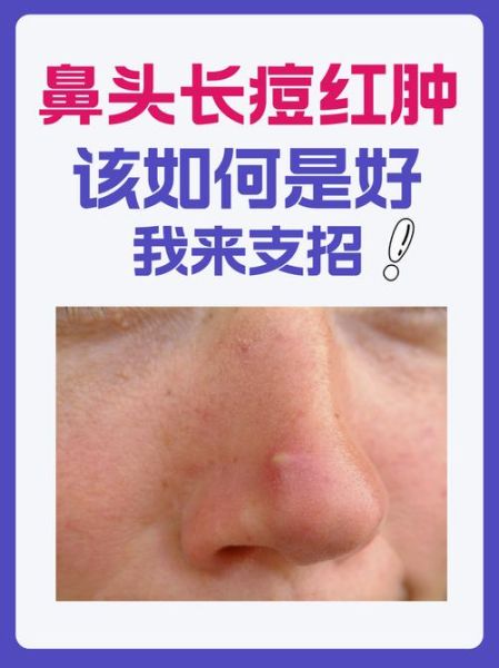 鼻头红肿运势_鼻头红肿预示什么