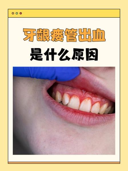 梦到牙出血是什么意思_梦见牙齿流血怎么办