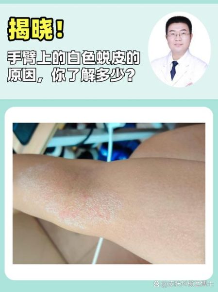 梦到皮肤脱皮_梦到皮肤变白是什么意思