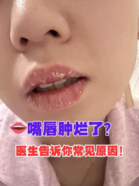 梦到嘴巴肿了是什么意思_如何化解