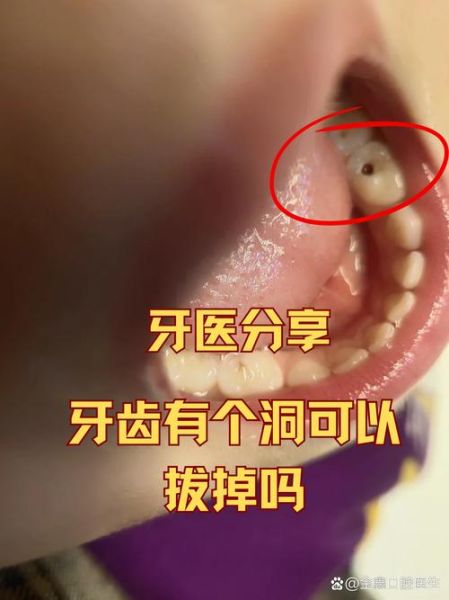 梦到牙齿有洞_梦见牙齿坏了是什么意思