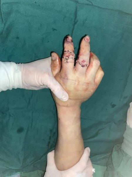 男人断手指财运会变差吗_断指后如何转运